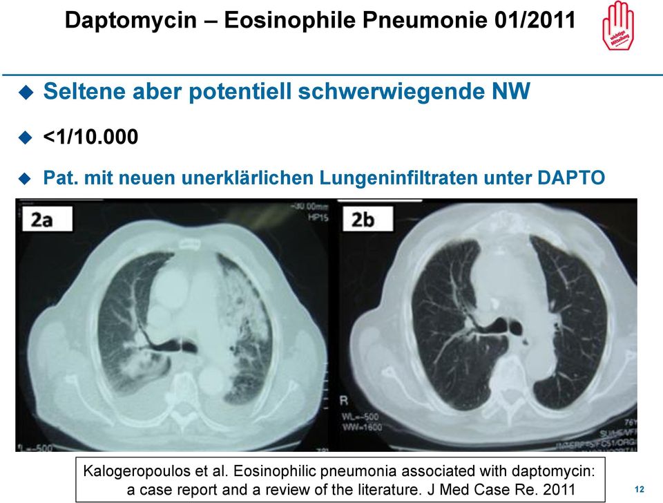 mit neuen unerklärlichen Lungeninfiltraten unter DAPTO Kalogeropoulos et