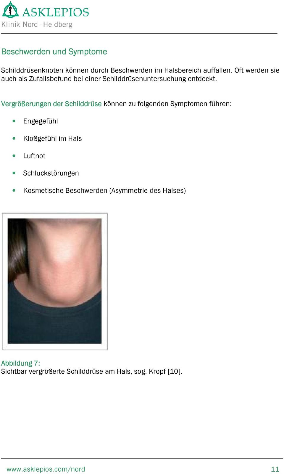 Vergrößerungen der Schilddrüse können zu folgenden Symptomen führen: Engegefühl Kloßgefühl im Hals Luftnot
