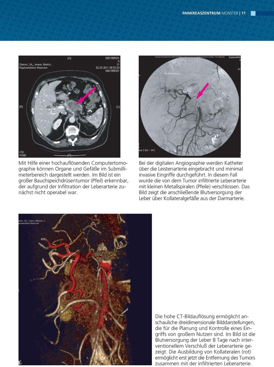 Bei der digitalen Angiographie werden Katheter über die Leistenarterie eingebracht und minimal invasive Eingriffe durchgeführt.