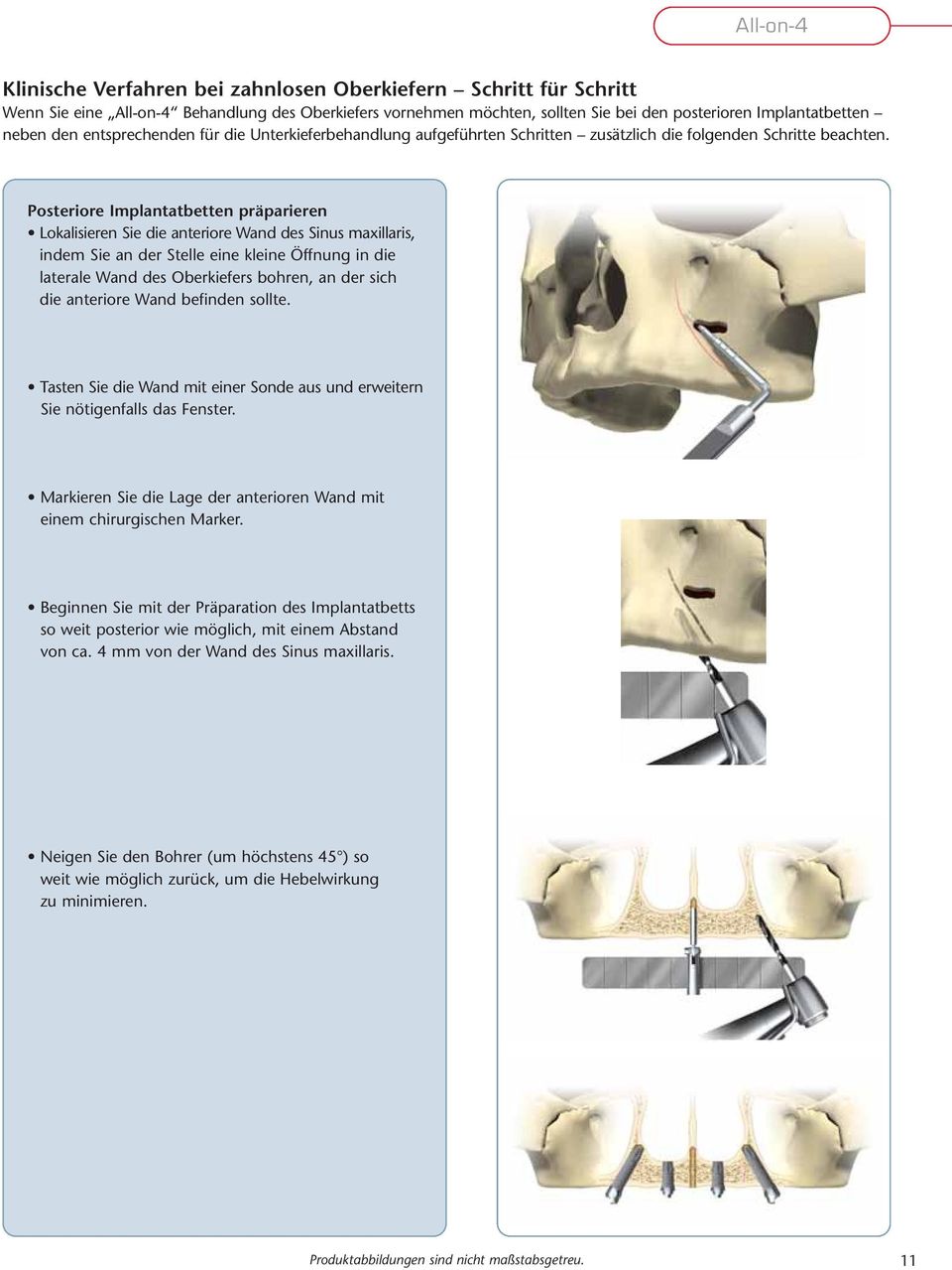 Posteriore Implantatbetten präparieren Lokalisieren Sie die anteriore Wand des Sinus maxillaris, indem Sie an der Stelle eine kleine Öffnung in die laterale Wand des Oberkiefers bohren, an der sich