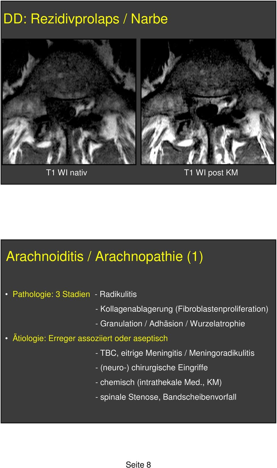 Wurzelatrophie Ätiologie: Erreger assoziiert oder aseptisch - TBC, eitrige Meningitis /