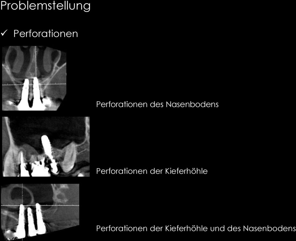 Perforationen der Kieferhöhle