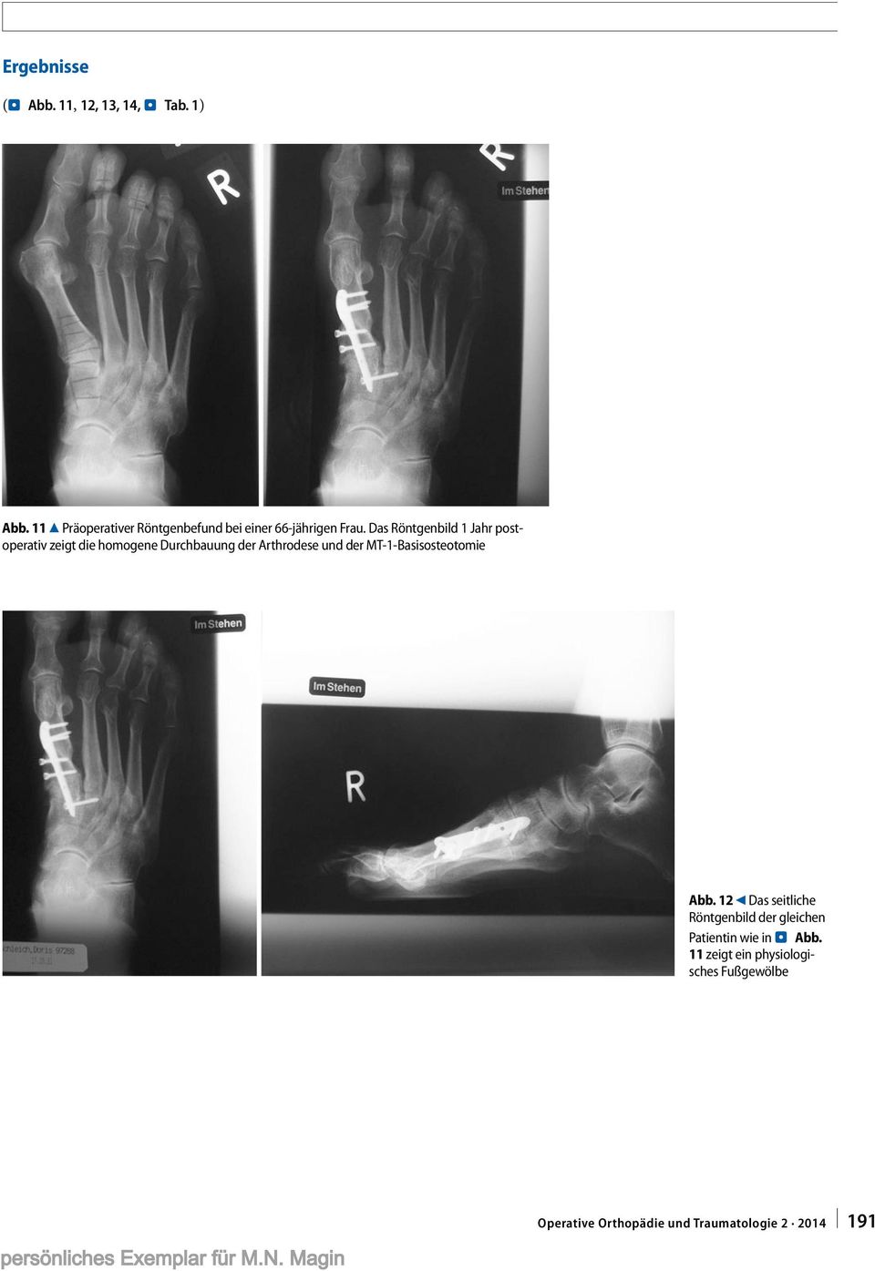 Das Röntgenbild 1 Jahr postoperativ zeigt die homogene Durchbauung der Arthrodese und der