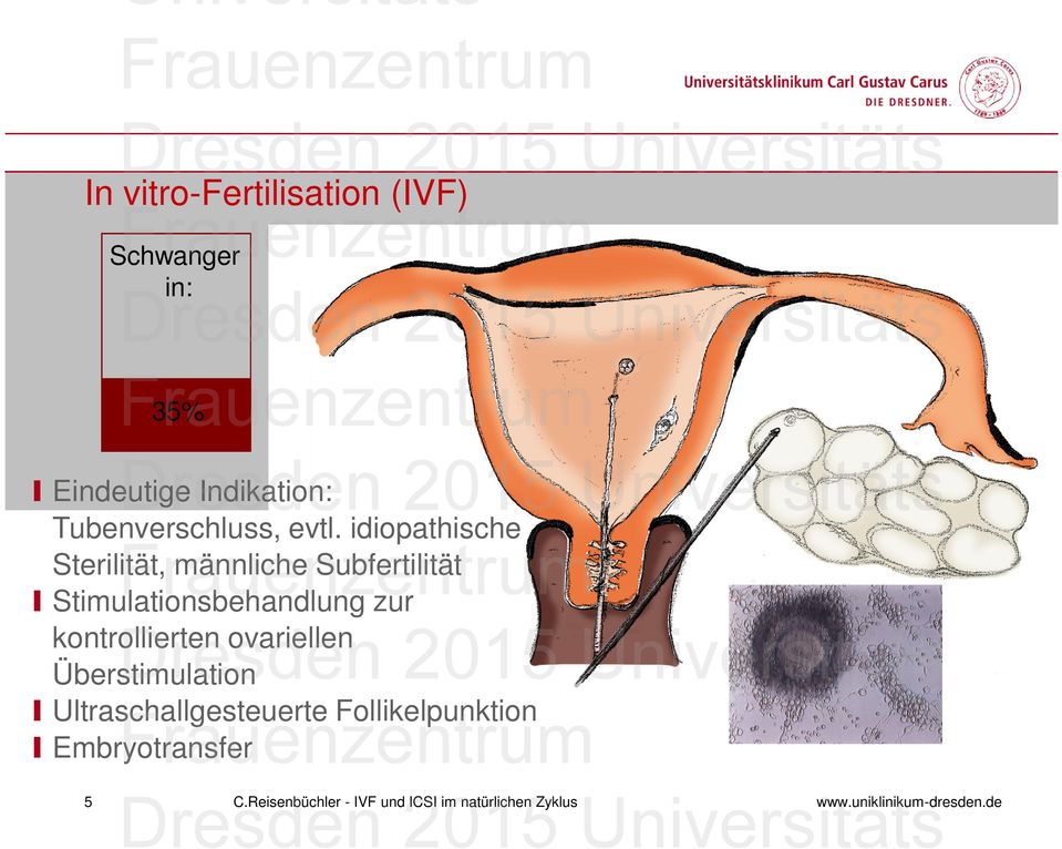 idiopathische Sterilität, männliche Subfertilität I
