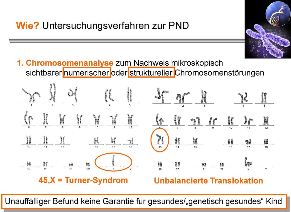 numerischer oder struktureller Chromosomenstörungen 45,X =