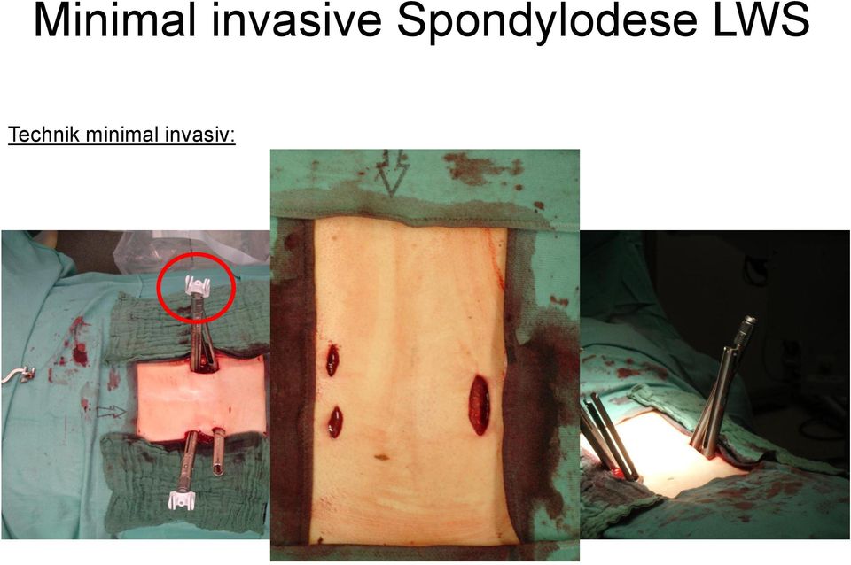 Spondylodese