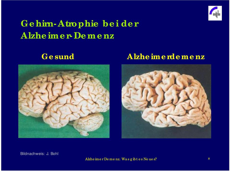 Alzheimerdemenz Bildnachweis: