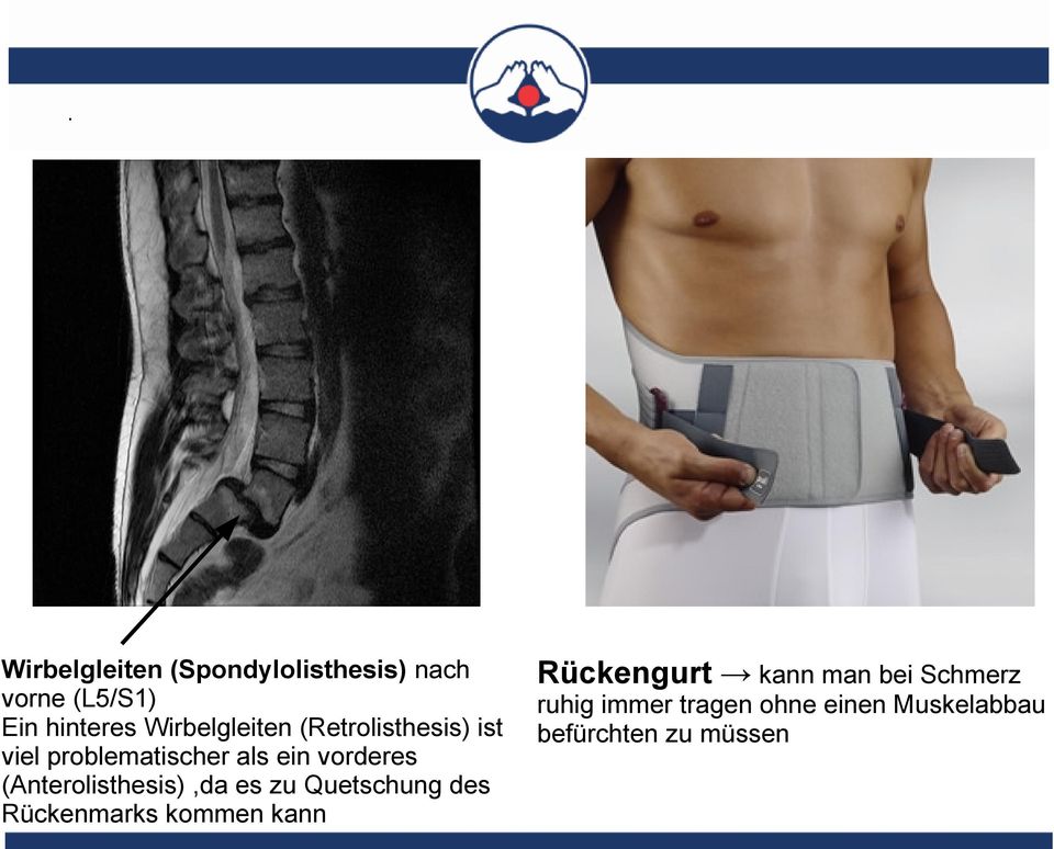 (Anterolisthesis),da es zu Quetschung des Rückenmarks kommen kann