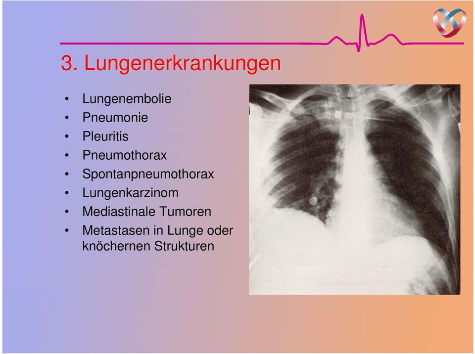 Spontanpneumothorax Lungenkarzinom