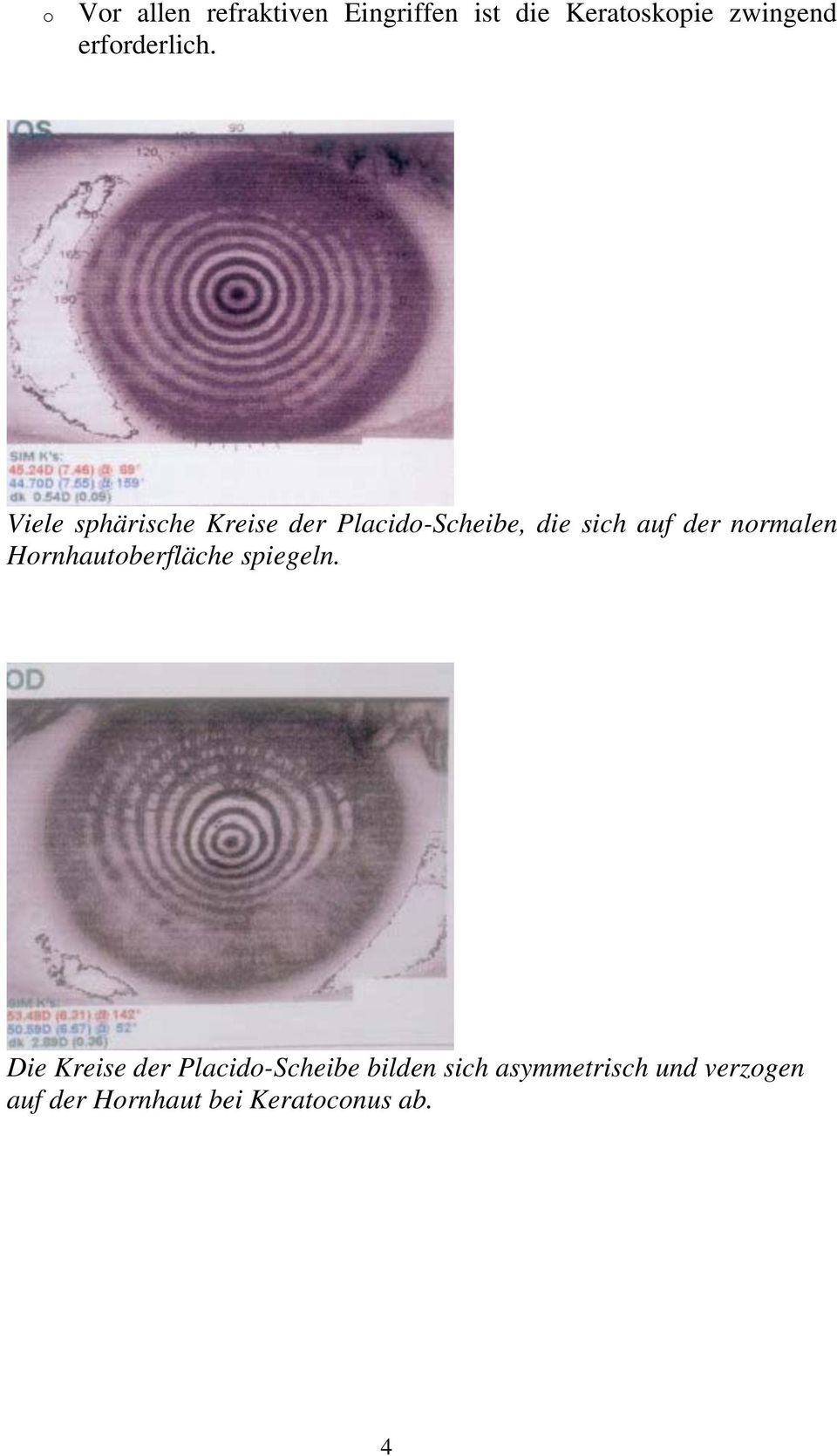 Viele sphärische Kreise der Placido-Scheibe, die sich auf der normalen