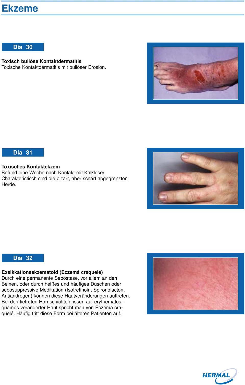 Dia 32 Exsikkationsekzematoid (Eczemá craquelé) Durch eine permanente Sebostase, vor allem an den Beinen, oder durch heißes und häufiges Duschen oder