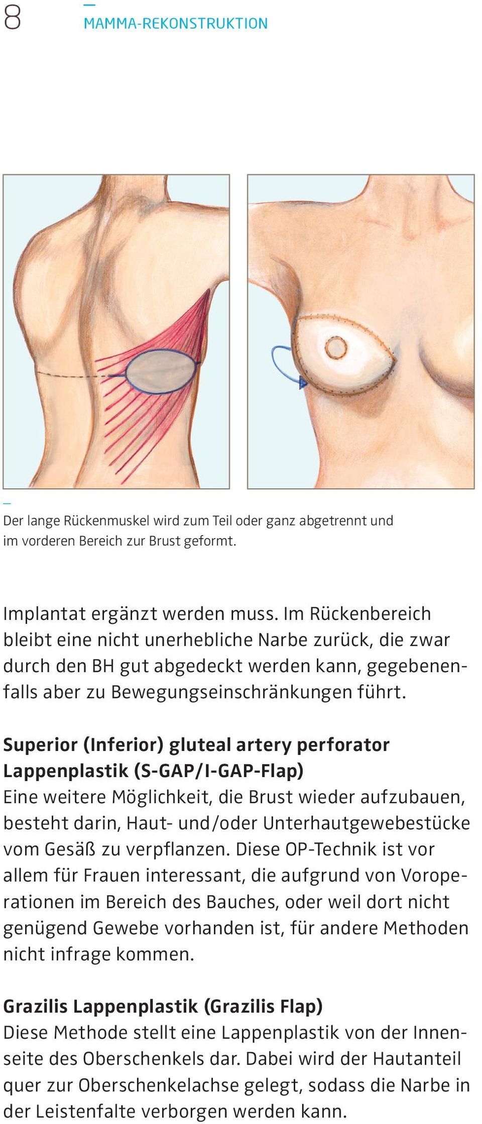 Superior (Inferior) gluteal artery perforator Lappenplastik (S-GAP/I-GAP-Flap) Eine weitere Möglichkeit, die Brust wieder aufzubauen, besteht darin, Haut- und/oder Unterhautgewebestücke vom Gesäß zu