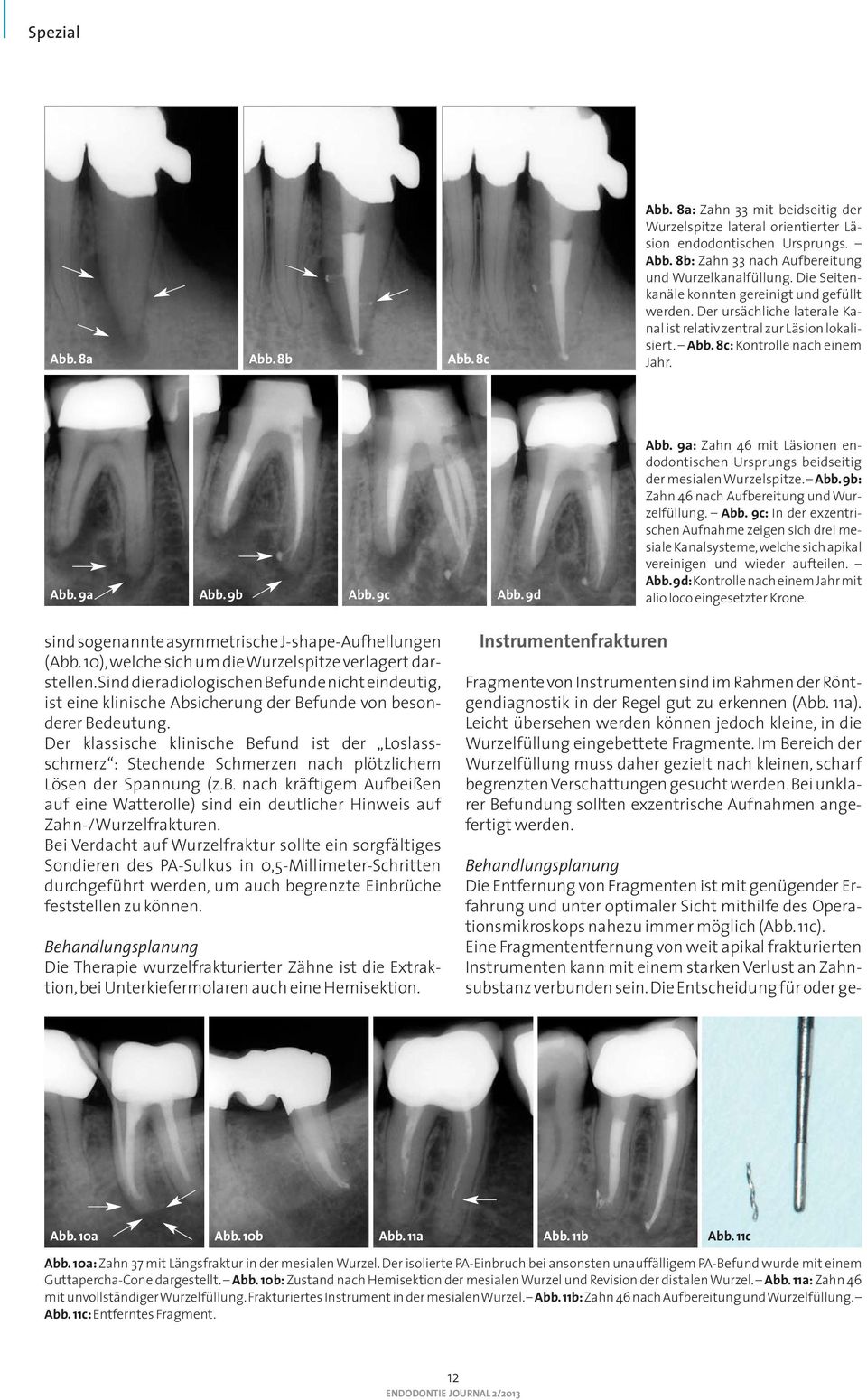 9d Abb. 9a: Zahn 46 mit Läsionen en - dodontischen Ursprungs beidseitig der mesialen Wurzelspitze. Abb. 9b: Zahn 46 nach Aufbereitung und Wurzelfüllung. Abb. 9c: In der exzentrischen Aufnahme zeigen sich drei mesiale Kanalsysteme, welche sich apikal vereinigen und wieder aufteilen.
