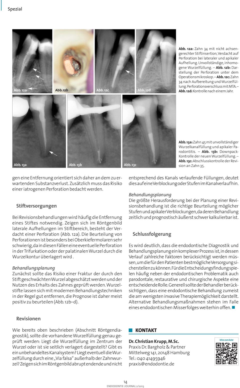 Abb. 12d: Kontrolle nach einem Jahr. Abb. 13a Abb. 13b Abb. 13c Abb. 13a: Zahn 45 mit unvollständiger Wurzelkanalfüllung und apikaler Parodontitis. Abb. 13b: Downpack- Kontrolle der neuen Wurzelfüllung.