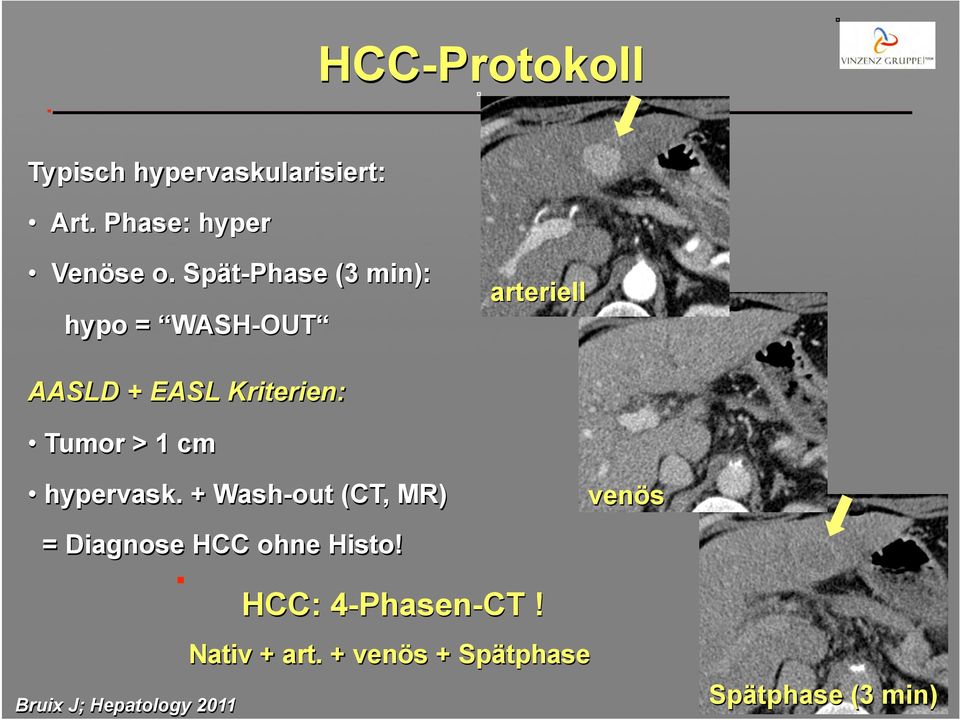 1 cm hypervask. + Wash-out (CT, MR) venös = Diagnose HCC ohne Histo!