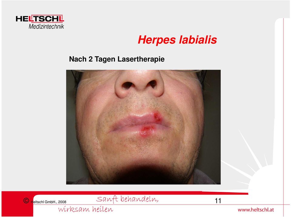 Herpes labialis