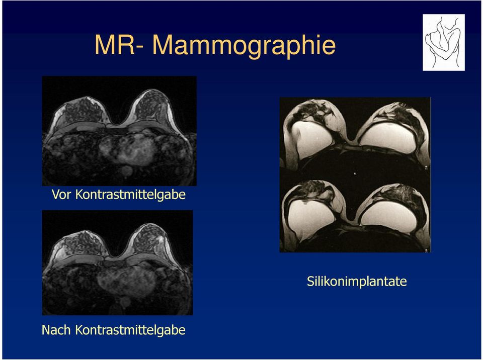 Silikonimplantate