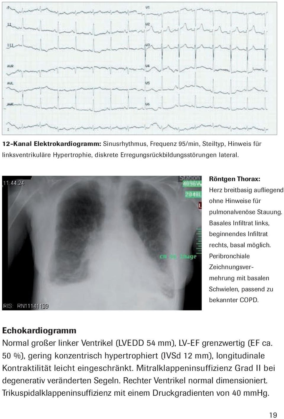Peribronchiale Zeichnungsvermehrung mit basalen Schwielen, passend zu bekannter COPD. Echokardiogramm Normal großer linker Ventrikel (LVEDD 54 mm), LV-EF grenzwertig (EF ca.