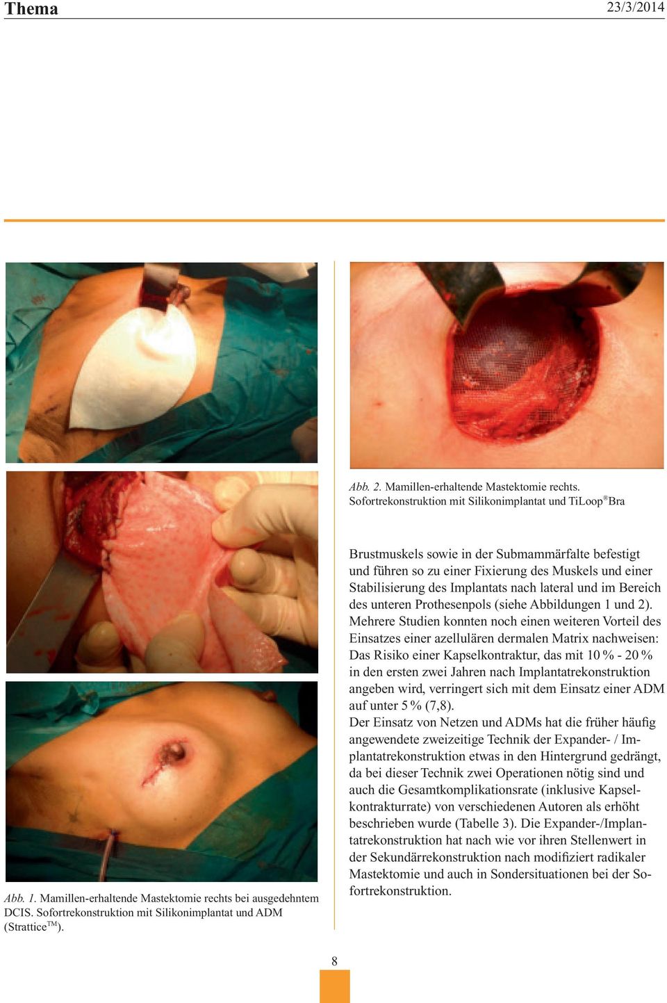 Sofortrekonstruktion mit Silikonimplantaten und Brustmuskels A) sowie in der Submammärfalte B) befestigt und führen so zu einer Fixierung des Muskels und einer Stabilisierung des Implantats nach