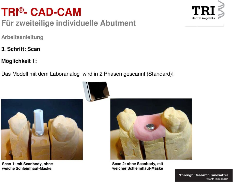 Scan 1: mit Scanbody, ohne weiche Schleimhaut-Maske