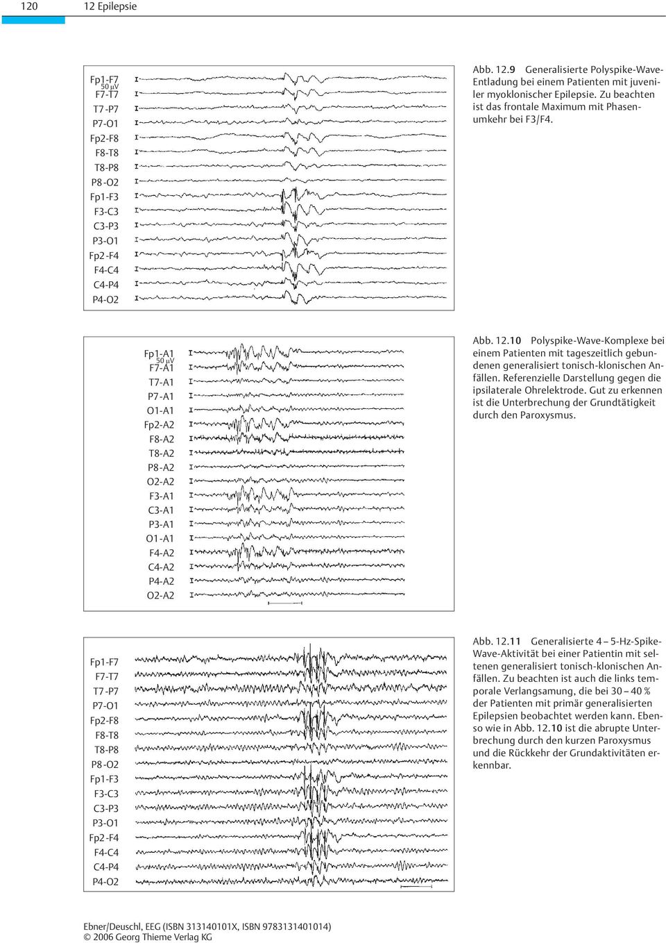 10 Polyspike-Wave-Komplexe bei einem Patienten mit tageszeitlich gebundenen generalisiert tonisch-klonischen Anfällen. Referenzielle Darstellung gegen die ipsilaterale Ohrelektrode.