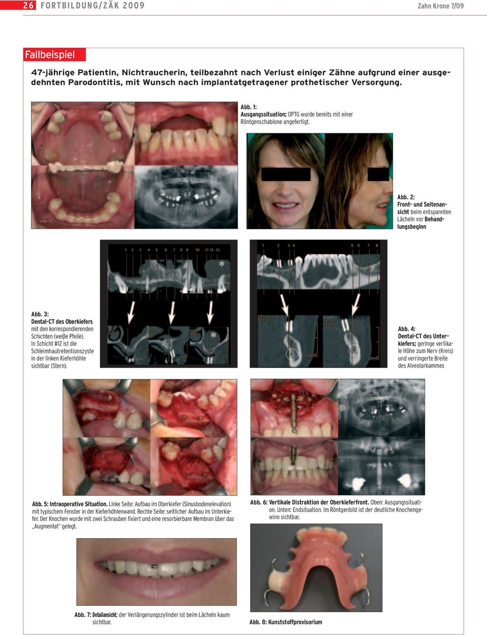 3: Dental-CT des Oberkiefers mit den korrespondierenden Schichten (weiße Pfeile). In Schicht #12 ist die Schleimhautretentionszyste in der linken Kieferhöhle sichtbar (Stern). Abb.