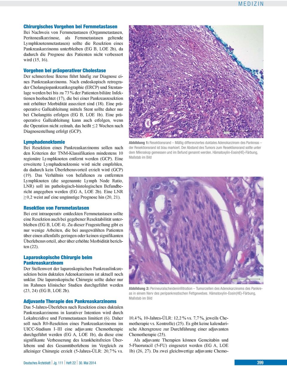 Vorgehen bei präoperativer Cholestase Der schmerzlose Ikterus führt häufig zur Diagnose eines Pankreaskarzinoms.