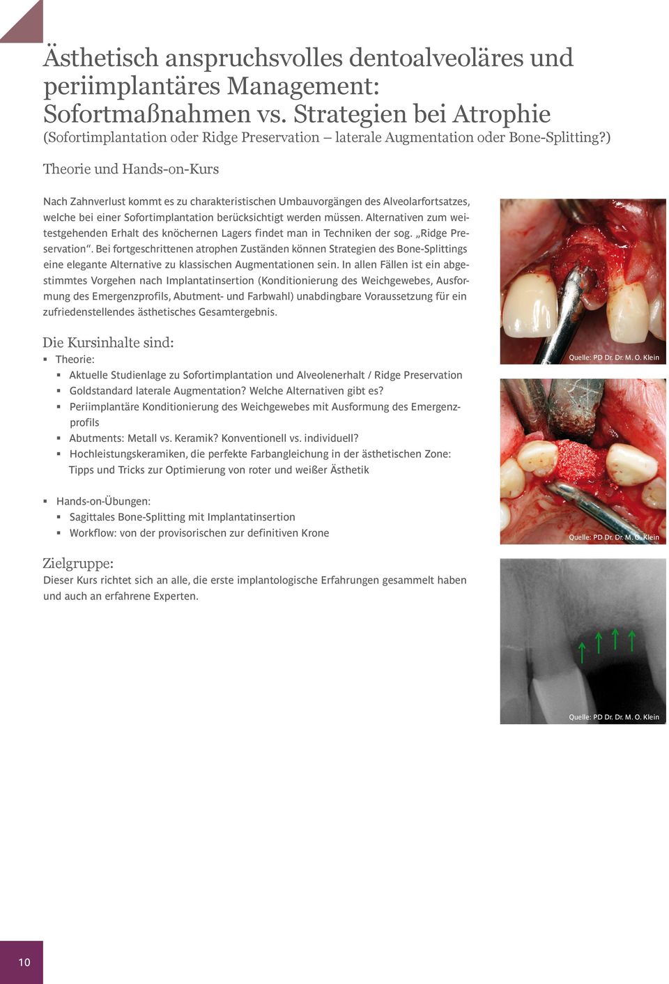 ) Theorie und Hands-on-Kurs Nach Zahnverlust kommt es zu charakteristischen Umbauvorgängen des Alveolarfortsatzes, welche bei einer Sofortimplantation berücksichtigt werden müssen.