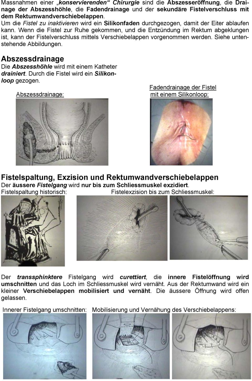 Wenn die Fistel zur Ruhe gekommen, und die Entzündung im Rektum abgeklungen ist, kann der Fistelverschluss mittels Verschiebelappen vorgenommen werden. Siehe untenstehende Abbildungen.