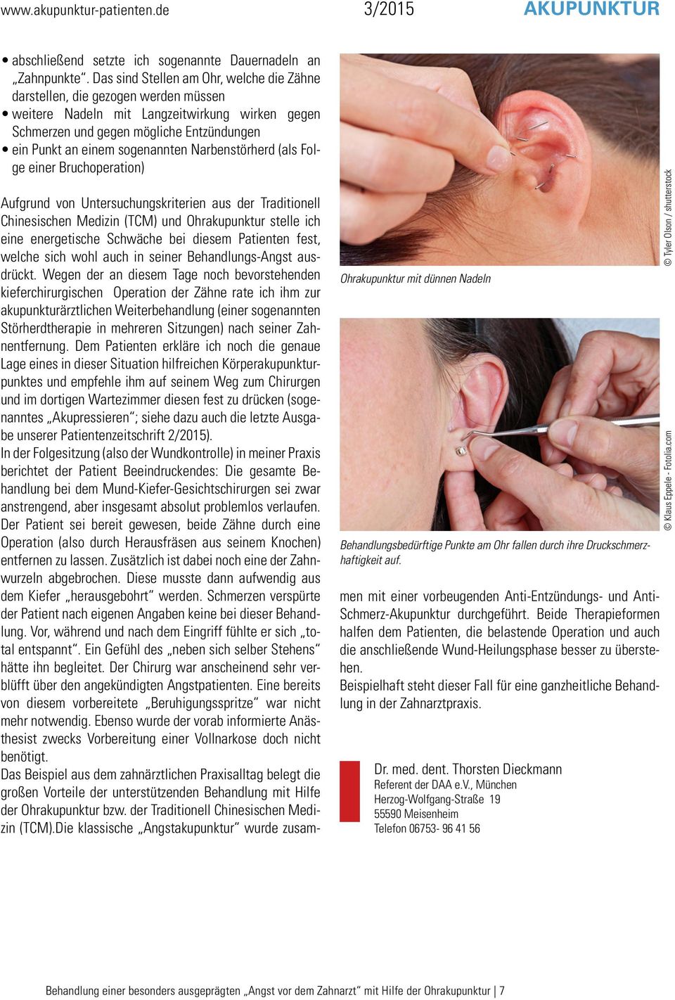 sogenannten Narbenstörherd (als Folge einer Bruchoperation) Ohrakupunktur mit dünnen Nadeln Behandlungsbedürftige Punkte am Ohr fallen durch ihre Druckschmerzhaftigkeit auf.