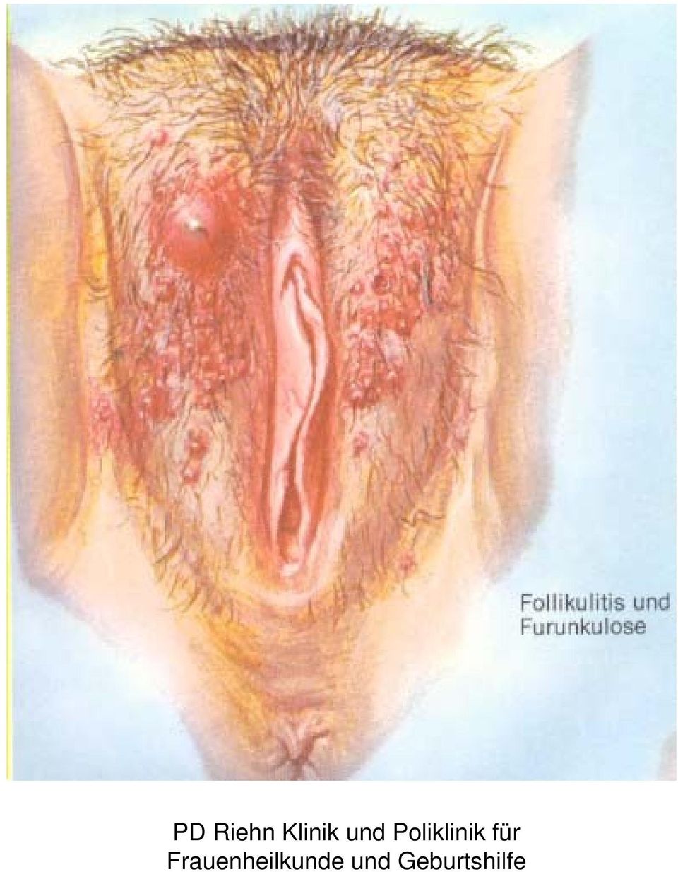 Bartholinischen entzündung drüse der Bartholinitis: Symptome,