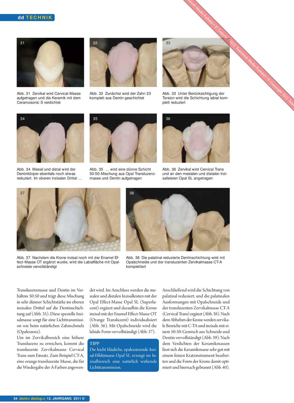 Im oberen inzisalen Drittel Abb. 35 wird eine dünne Schicht 50:50-Mischung aus Opal Transluzenzmasse und Dentin aufgetragen Abb.