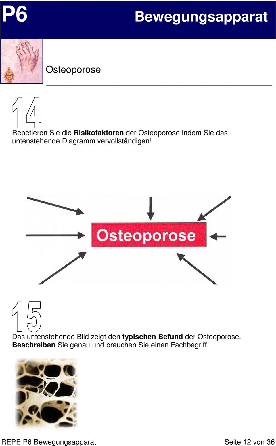 Das untenstehende Bild zeigt den typischen Befund der Osteoporose.