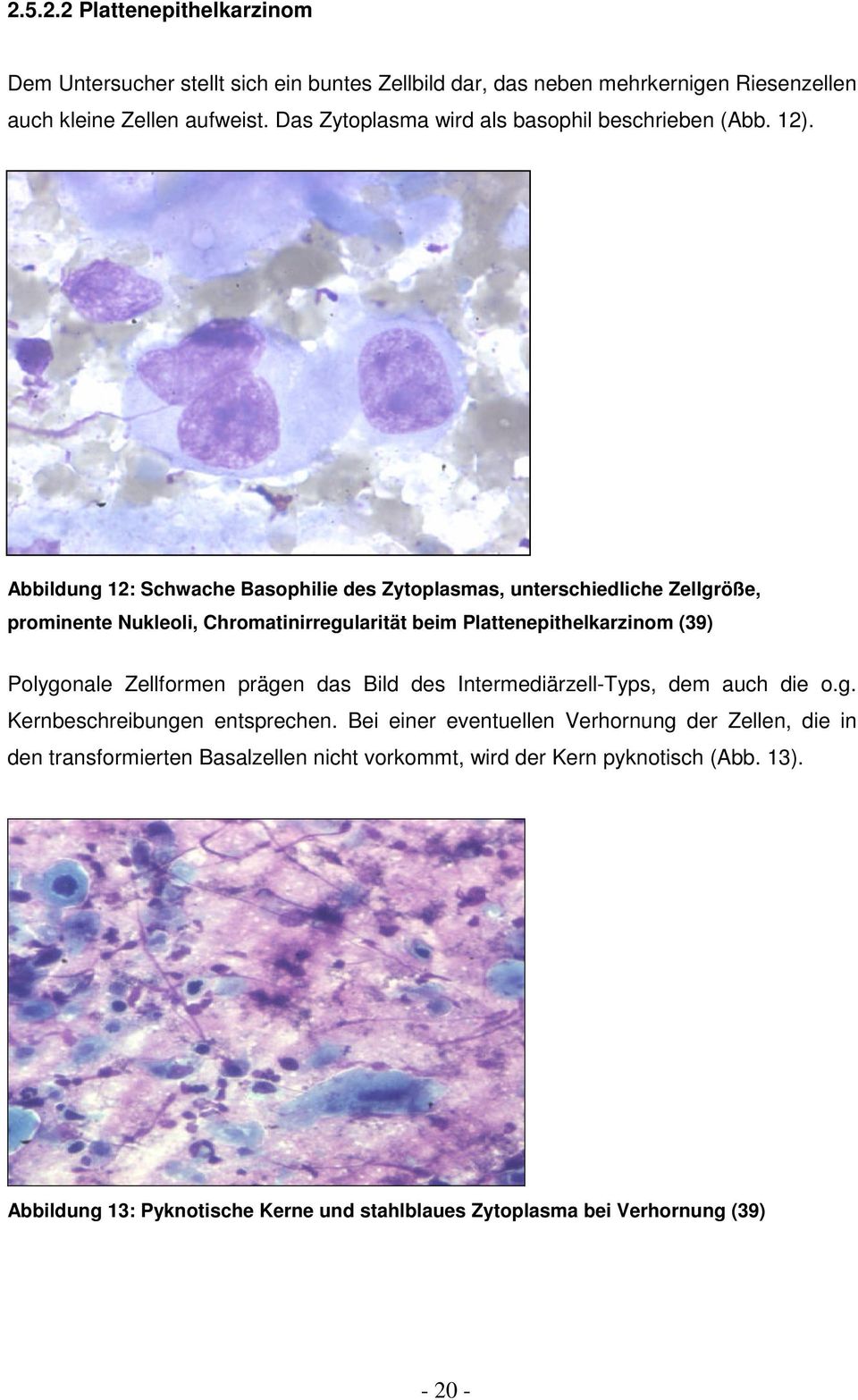 Abbildung 12: Schwache Basophilie des Zytoplasmas, unterschiedliche Zellgröße, prominente Nukleoli, Chromatinirregularität beim Plattenepithelkarzinom (39) Polygonale