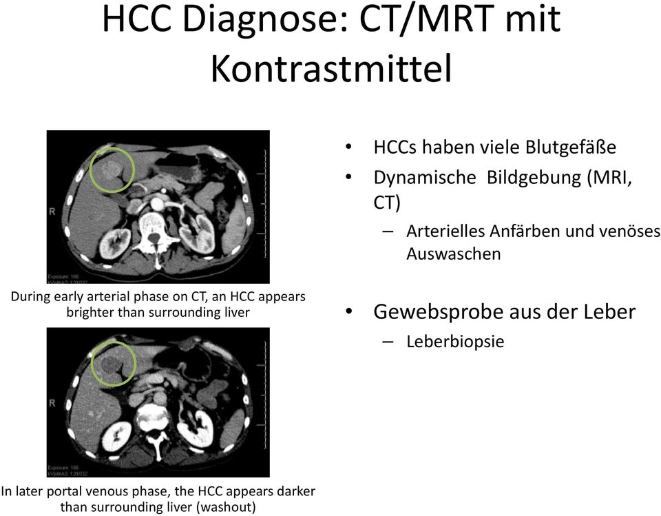 phase on CT, an HCC appears brighter than surrounding liver Gewebsprobe aus der Leber