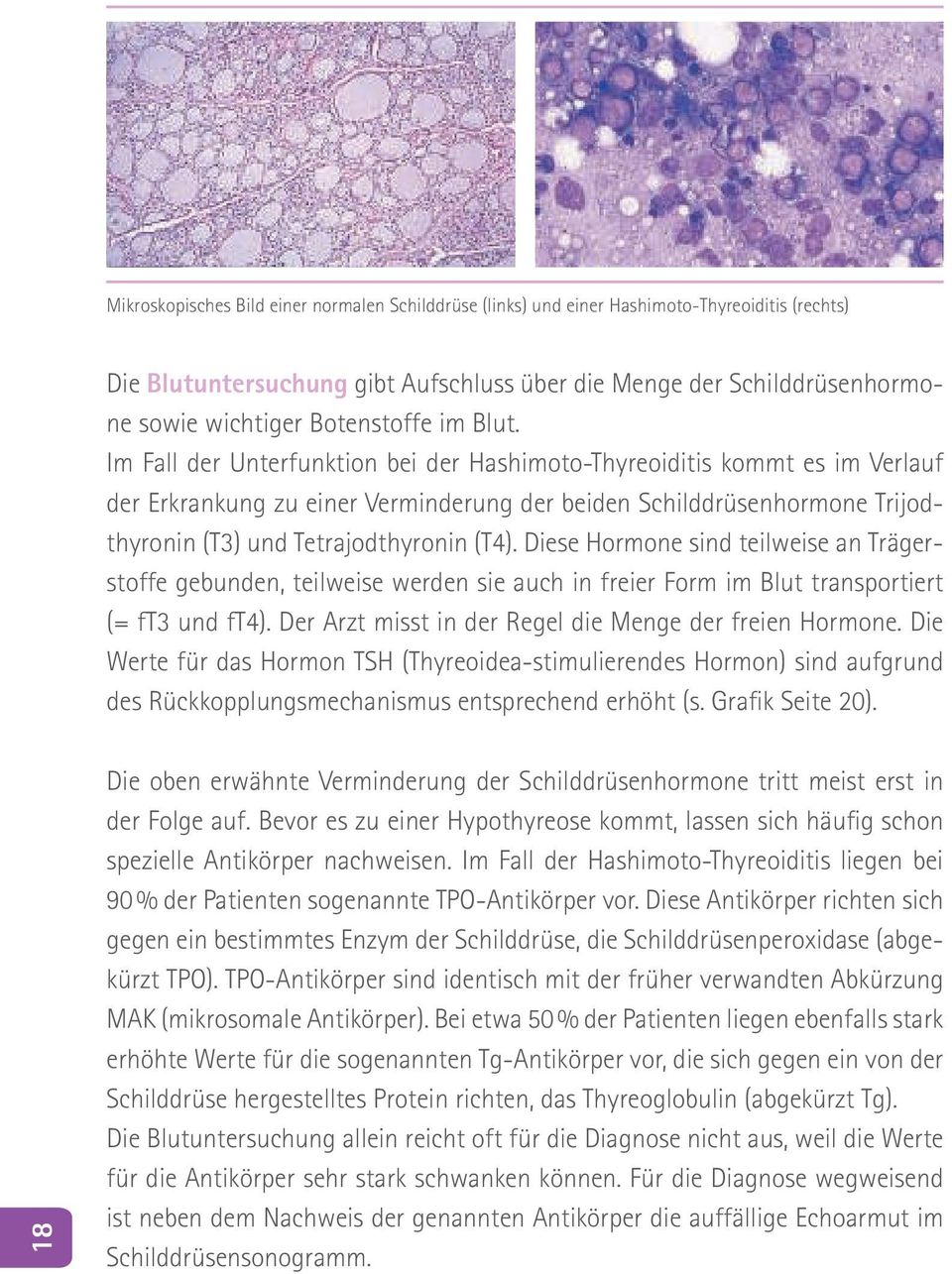 Im Fall der Unterfunktion bei der Hashimoto-Thyreoiditis kommt es im Verlauf der Erkrankung zu einer Verminderung der beiden Schilddrüsenhormone Trijodthyronin (T3) und Tetrajodthyronin (T4).