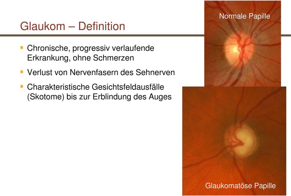 Gesichtsfeldausfälle (Skotome) bis zur Erblindung des Auges Glaukomatöse Papille 16