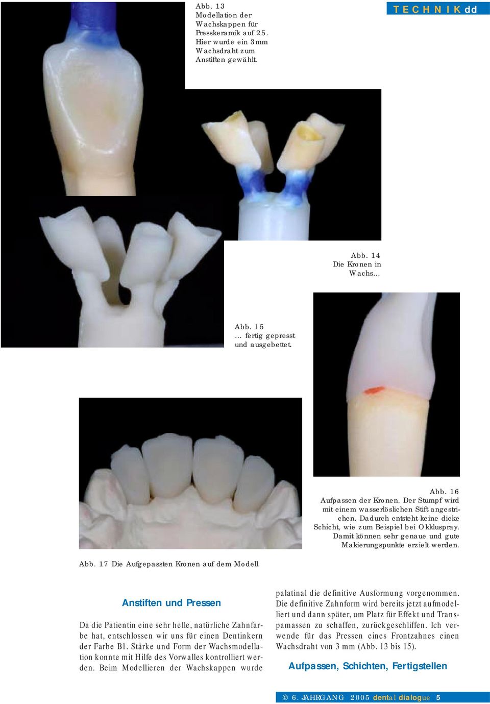 Abb. 17 Die Aufgepassten Kronen auf dem Modell. Anstiften und Pressen Da die Patientin eine sehr helle, natürliche Zahnfarbe hat, entschlossen wir uns für einen Dentinkern der Farbe B1.