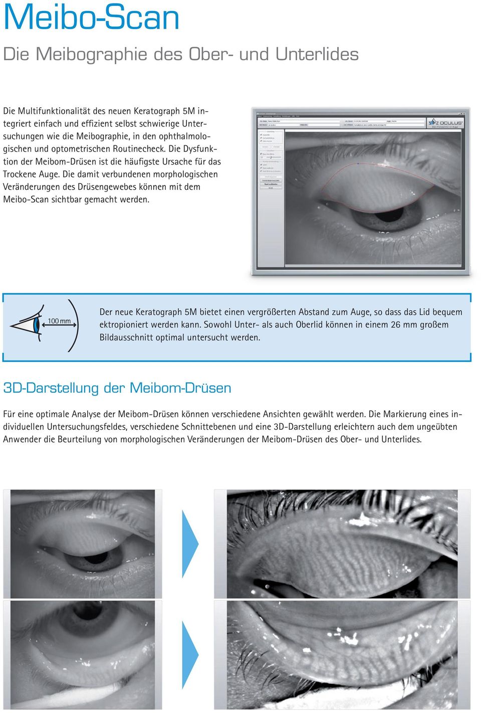 Die damit verbundenen morphologischen Veränderungen des Drüsengewebes können mit dem Meibo-Scan sichtbar gemacht werden.