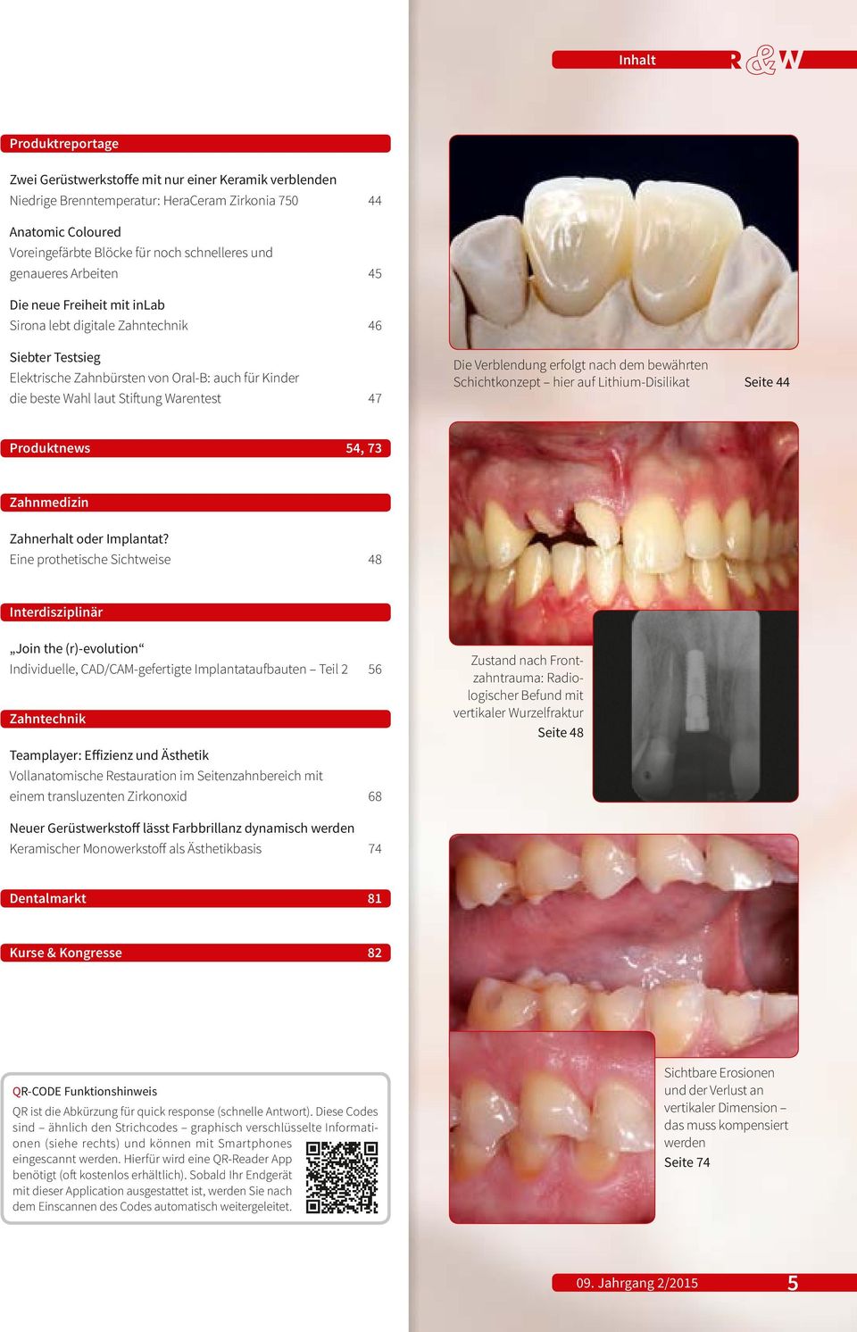 Die Verblendung erfolgt nach dem bewährten Schichtkonzept hier auf Lithium-Disilikat Seite 44 Produktnews 54, 73 Zahnmedizin Zahnerhalt oder Implantat?
