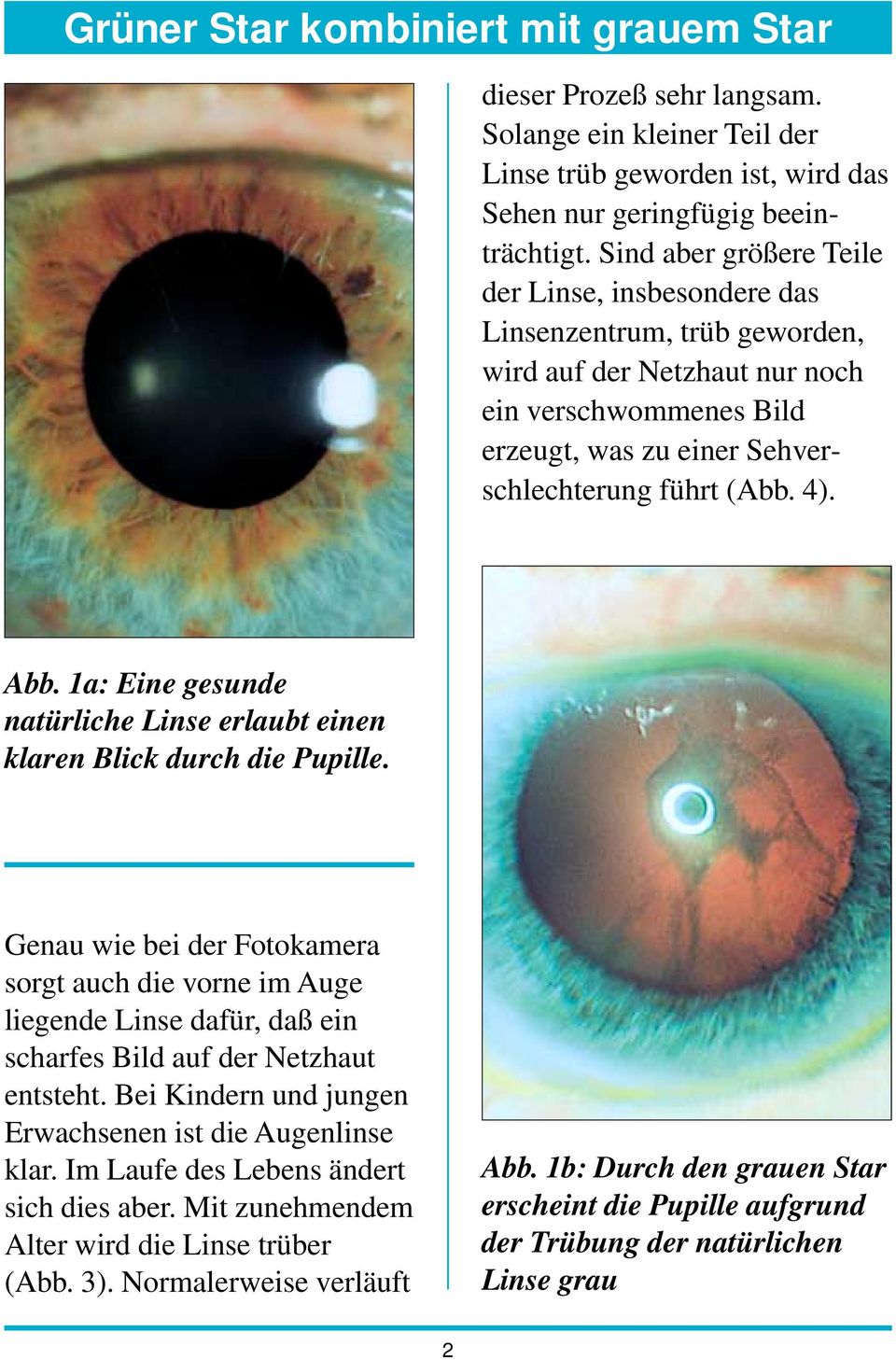 1a: Eine gesunde natürliche Linse erlaubt einen klaren Blick durch die Pupille.