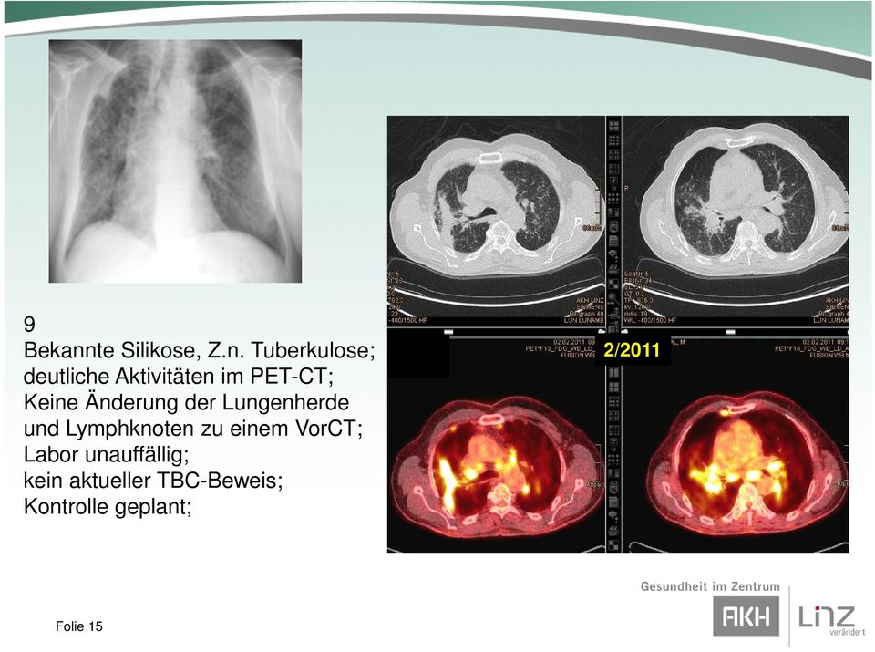 Tuberkulose; deutliche Aktivitäten im PET-CT; Keine