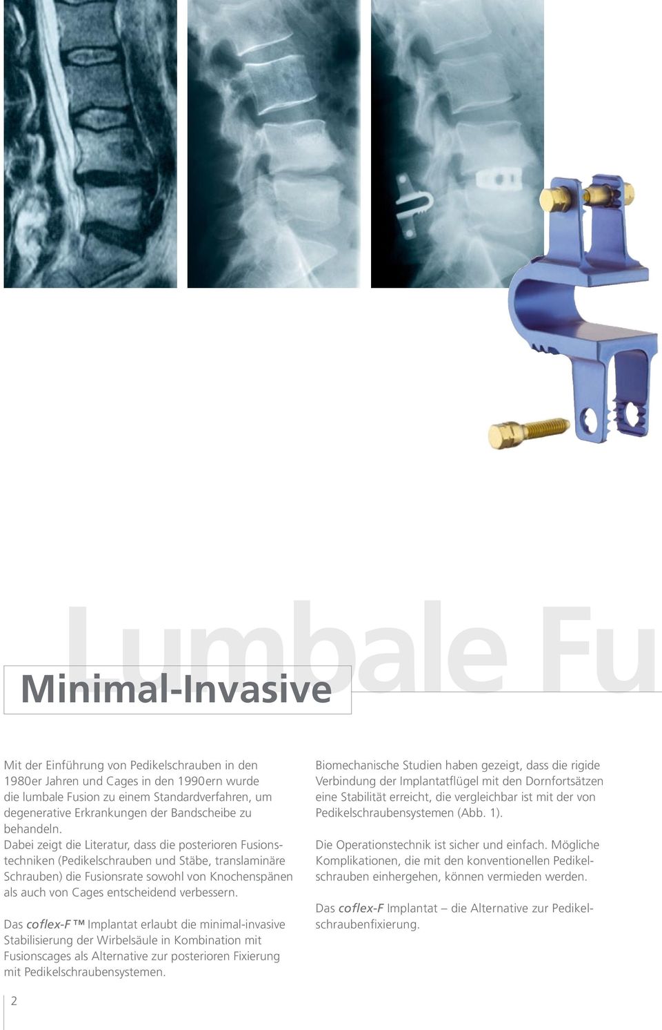 Dabei zeigt die Literatur, dass die posterioren Fusionstechniken (Pedikelschrauben und Stäbe, translaminäre Schrauben) die Fusionsrate sowohl von Knochenspänen als auch von Cages entscheidend