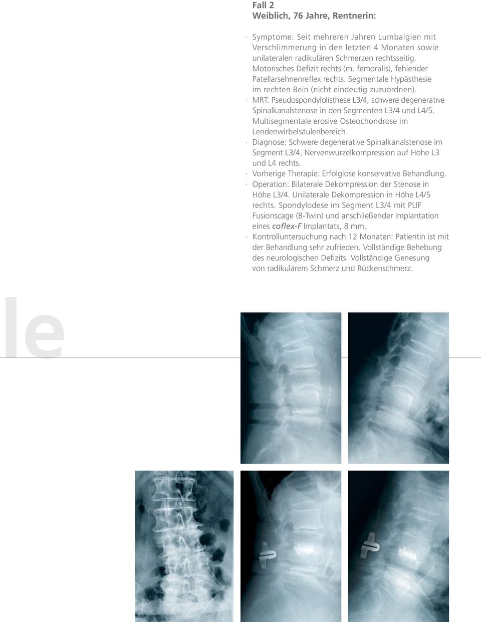 MRT: Pseudospondylolisthese L3/4, schwere degenerative Spinalkanalstenose in den Segmenten L3/4 und L4/5. Multisegmentale erosive Osteochondrose im Lendenwirbelsäulenbereich.