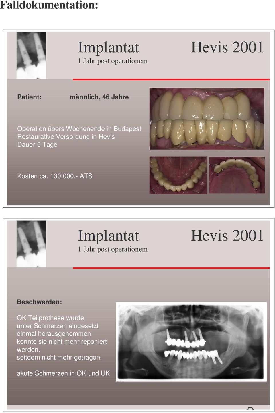 - ATS Implantat 1 Jahr post operationem Hevis 2001 Beschwerden: OK Teilprothese wurde unter Schmerzen
