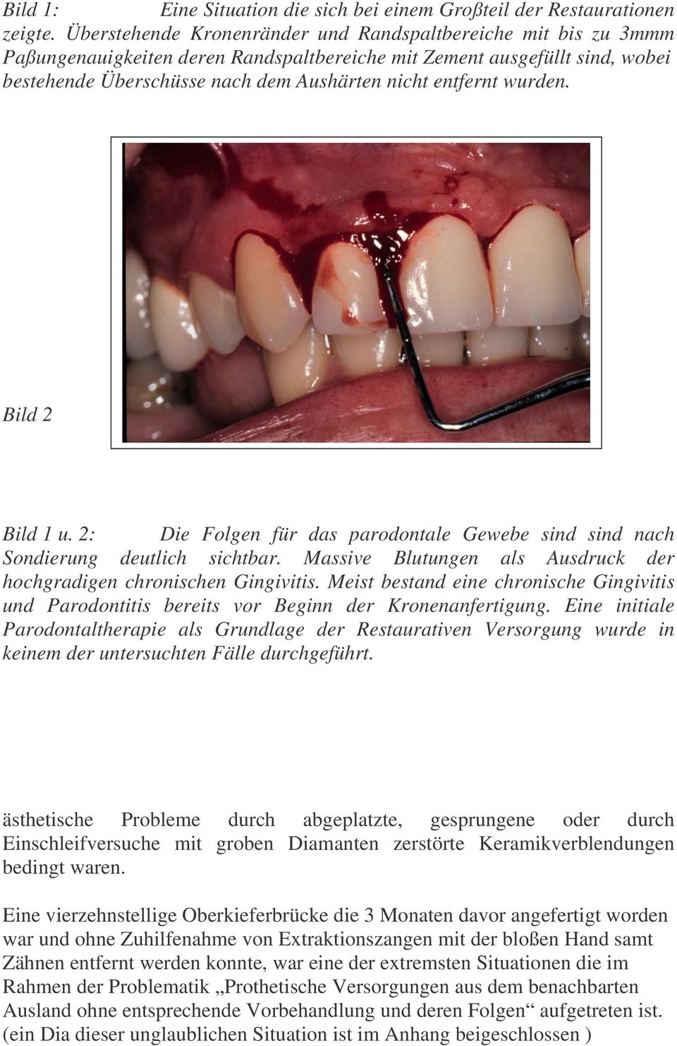 wurden. Bild 2 Bild 1 u. 2: Die Folgen für das parodontale Gewebe sind sind nach Sondierung deutlich sichtbar. Massive Blutungen als Ausdruck der hochgradigen chronischen Gingivitis.