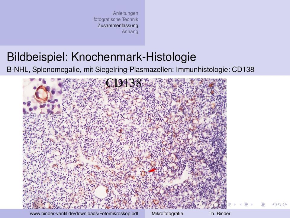 Siegelring-Plasmazellen: Immunhistologie: CD138