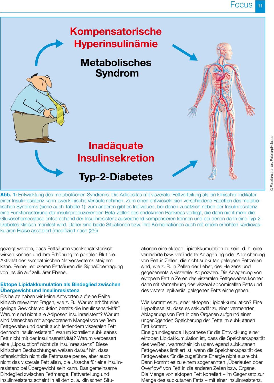 Zum einen entwickeln sich verschiedene Facetten des metabolischen Syndroms (siehe auch Tabelle 1), zum anderen gibt es Individuen, bei denen zusätzlich neben der Insulinresistenz eine