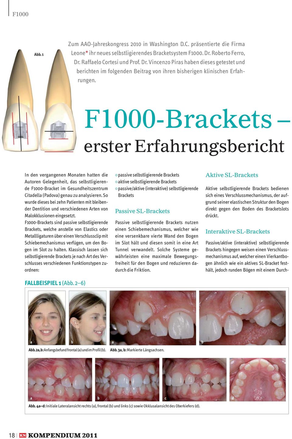 F1000-Brkets erster Erfhrungseriht In den vergngenen Monten htten die Autoren Gelegenheit, ds selstligierende F1000-Brket im Gesundheitszentrum Ci t dell (P dov) genu zu nlysieren.