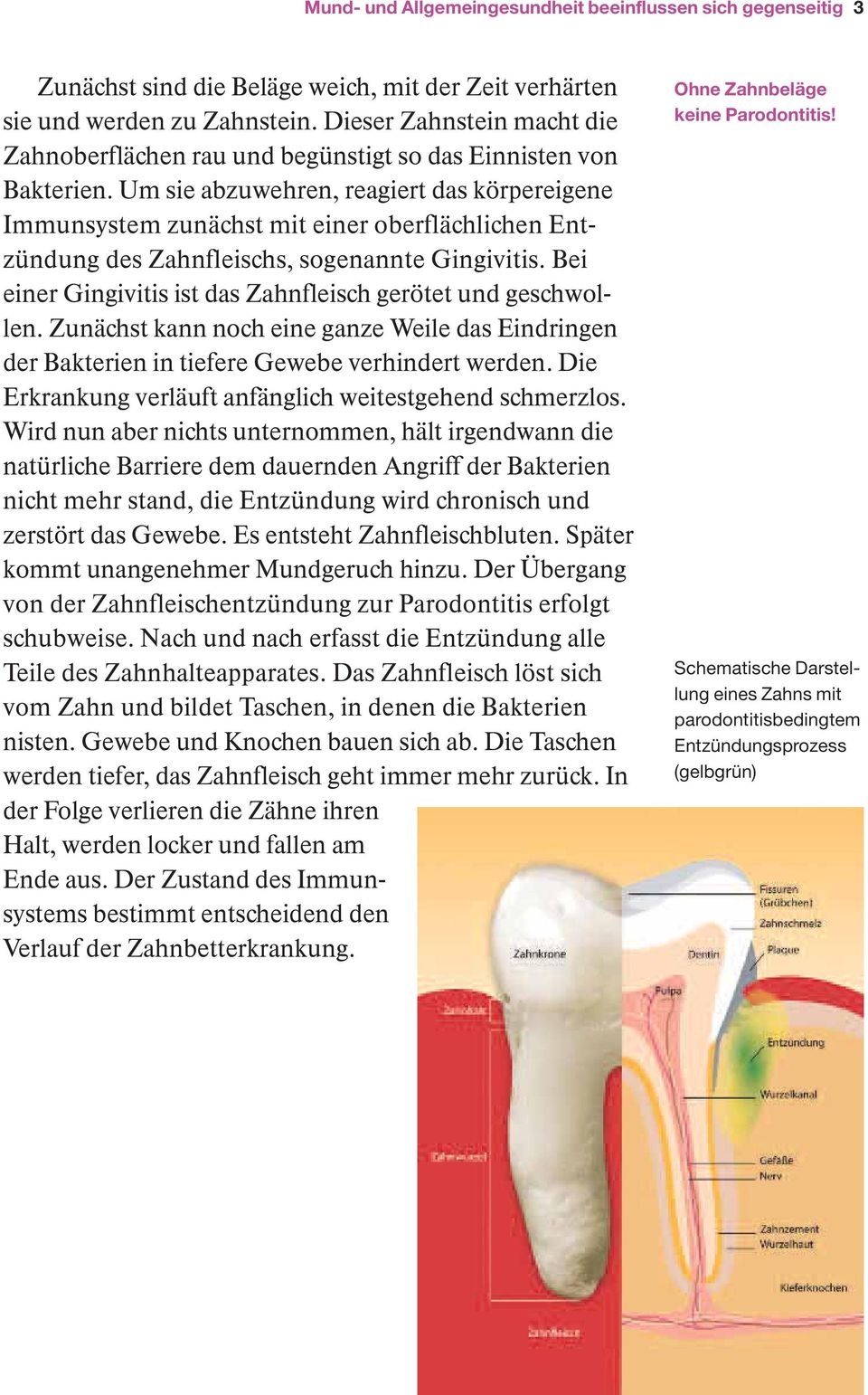 Um sie abzuwehren, reagiert das körpereigene Immunsystem zunächst mit einer oberflächlichen Entzündung des Zahnfleischs, sogenannte Gingivitis.